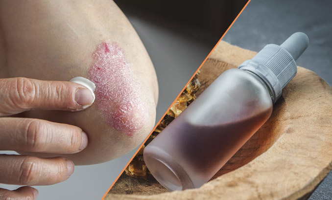 sedef-hastalari-hangi-vitaminleri-kullanmali