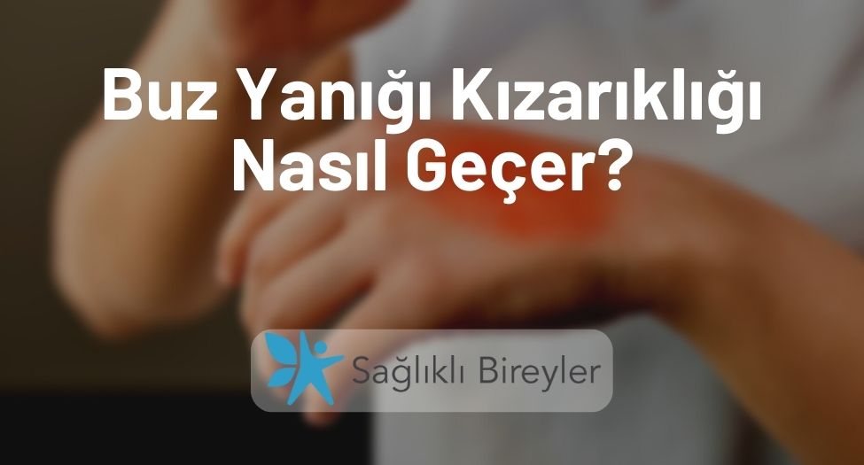 Buz Yanığı Kızarıklığı Nasıl Geçer