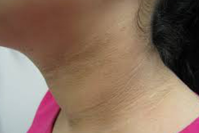 acanthosis-nigricans-nedir