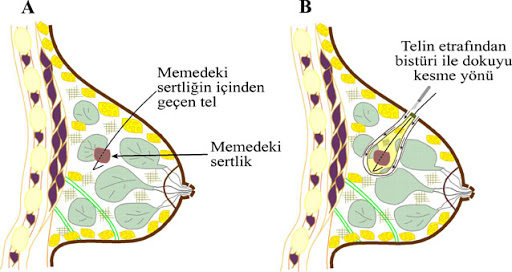 subareolar-memede-ne-demek