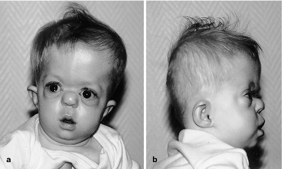 antley-bixler-sendromu