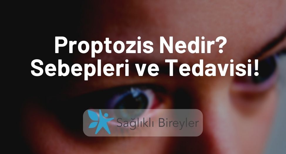 Proptozis Nedir