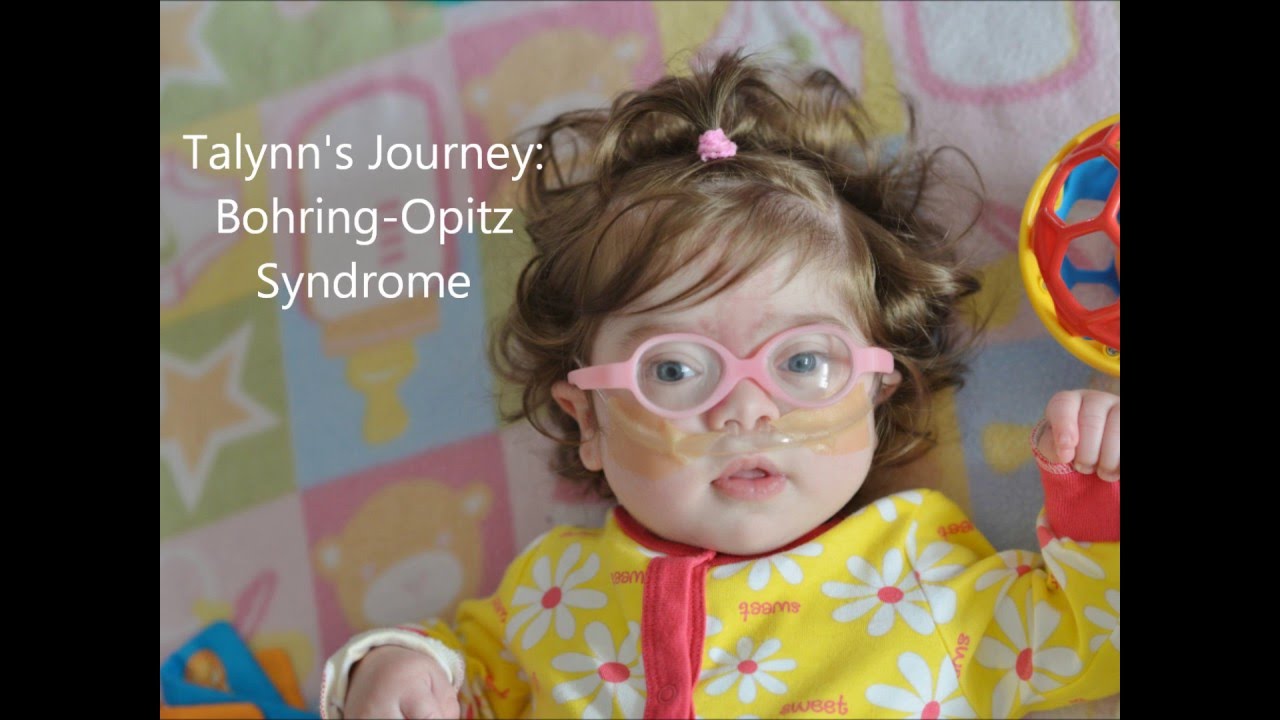 bohring-opitz-sendromu-nedir